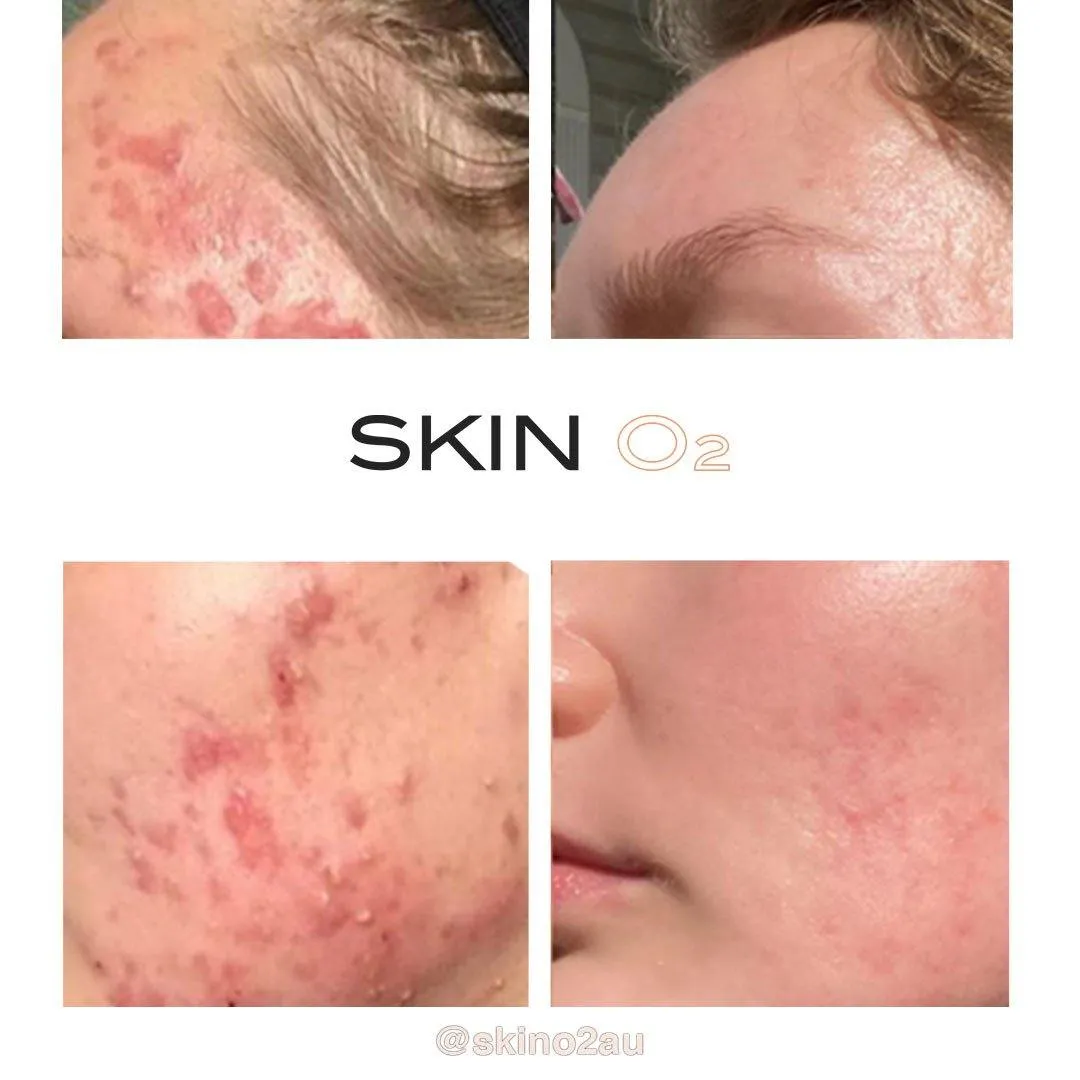 Acne Clean Skin Pack