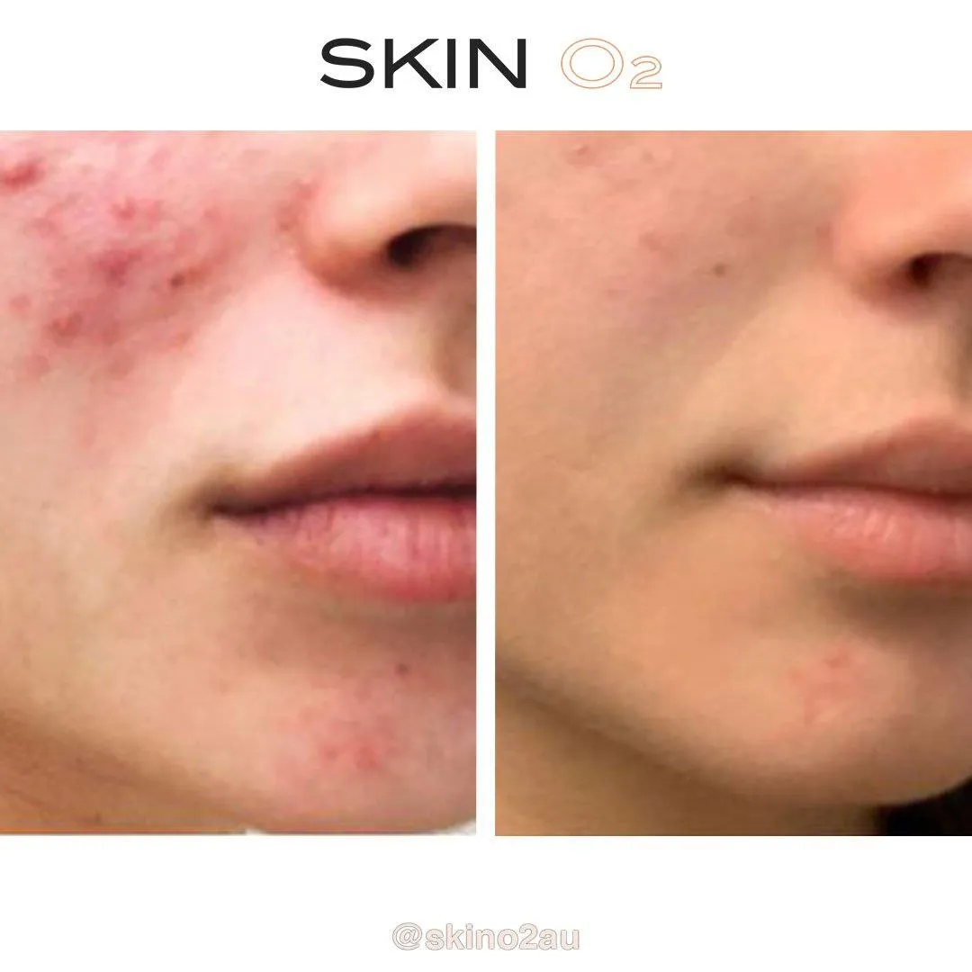 Acne Clean Skin Pack