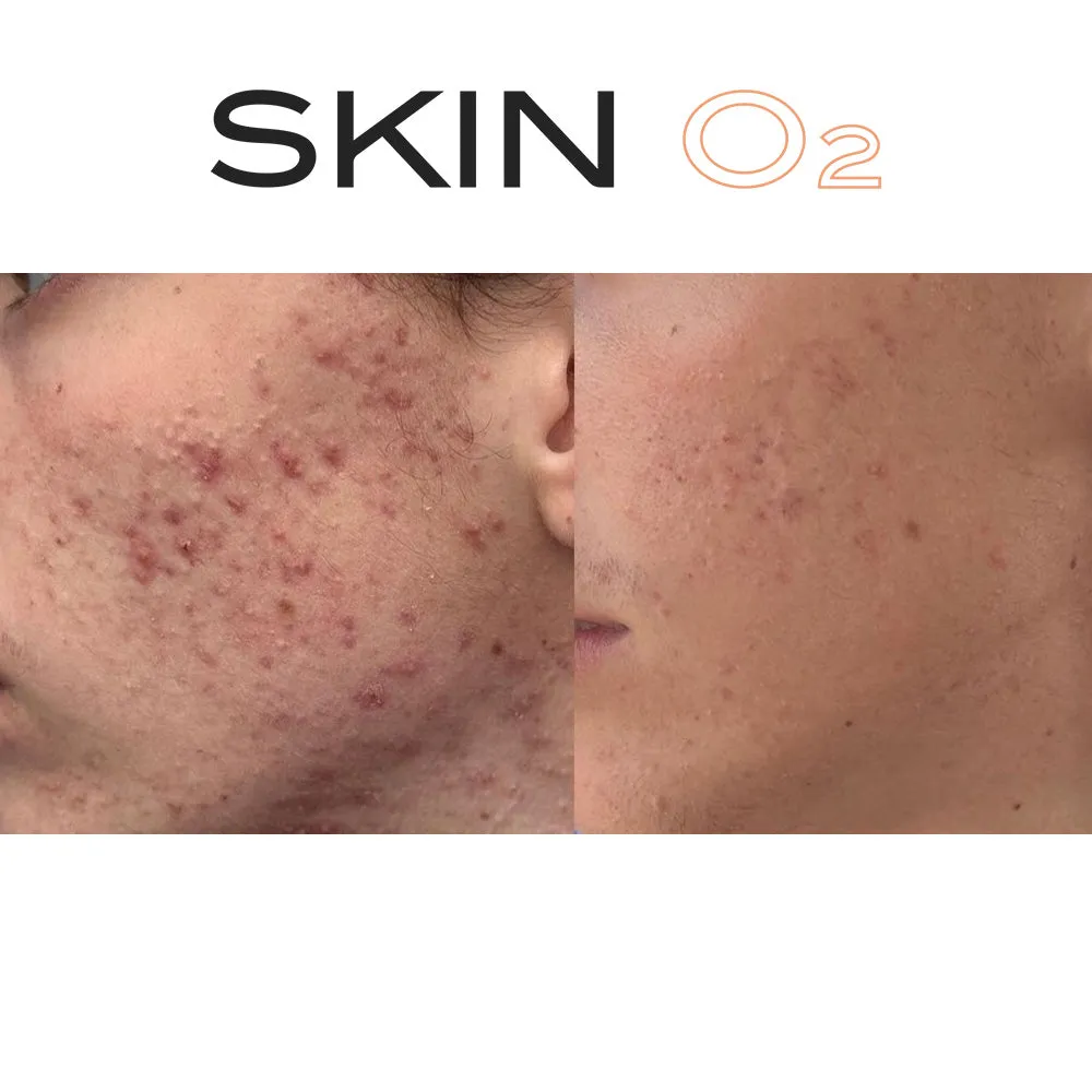 Acne Clean Skin Pack